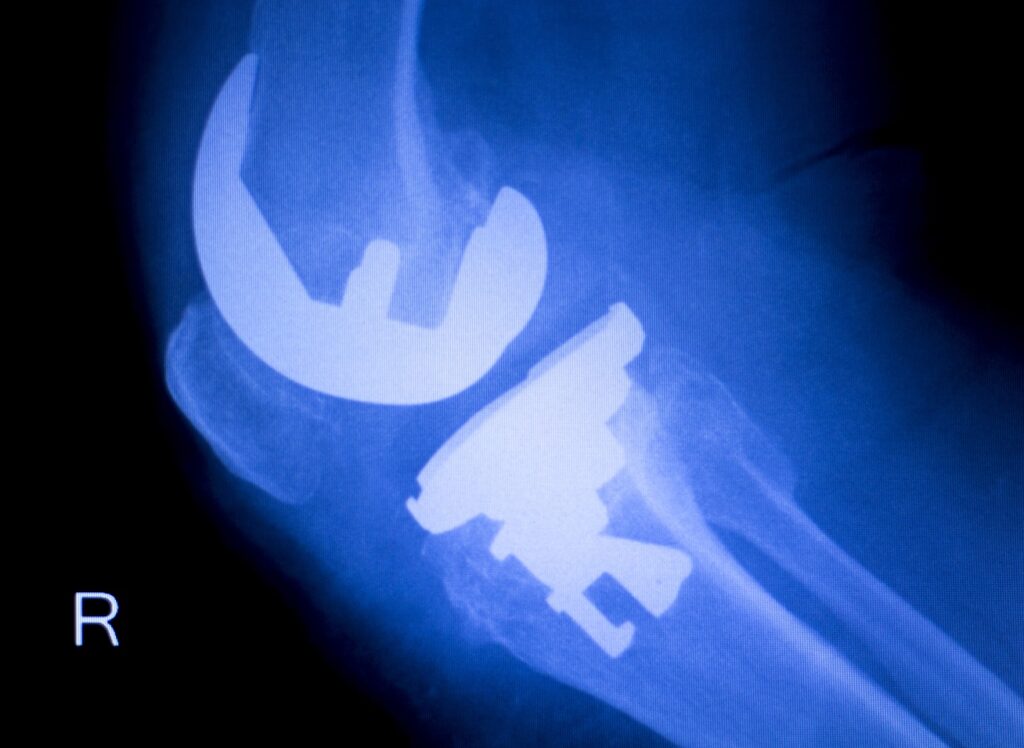 x-ray of knee replacement medical device implant